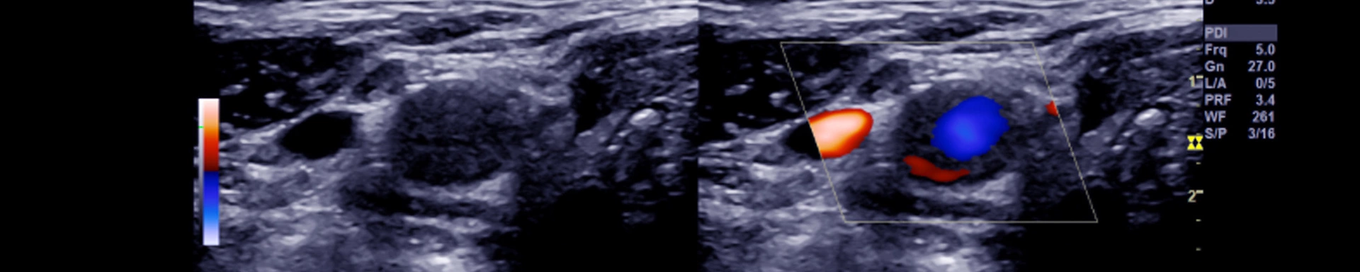 Beinvenenthrombose